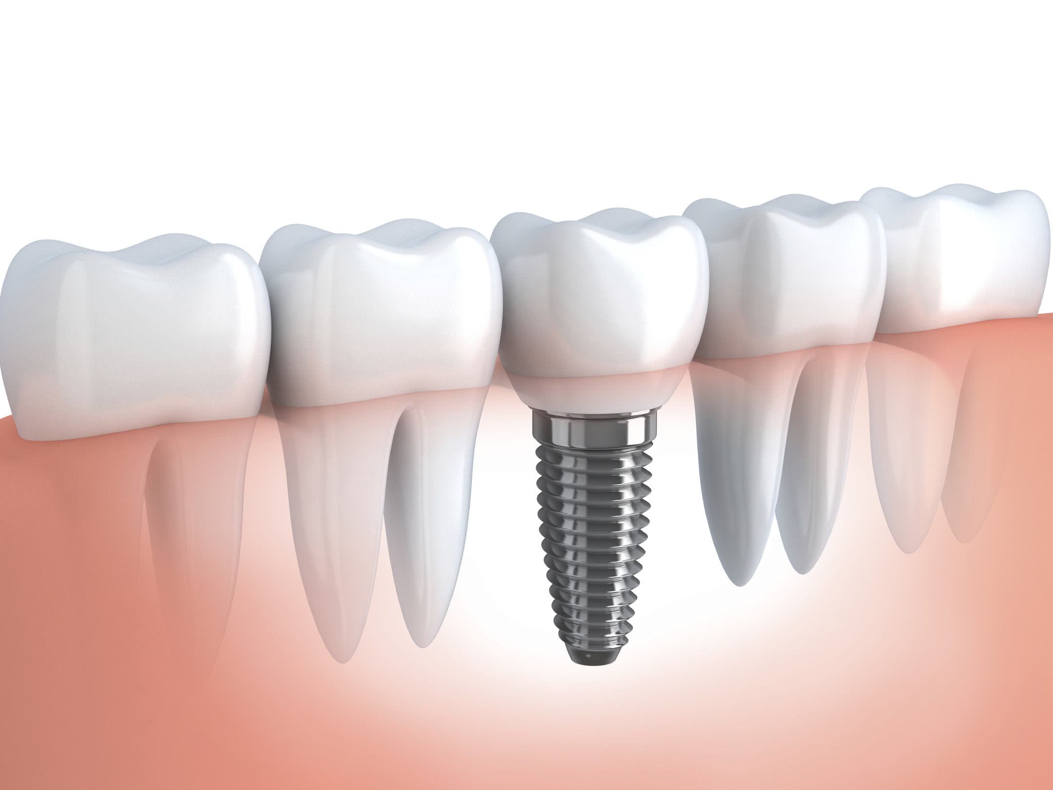 implantes dentais Dr Flavio Ferraz